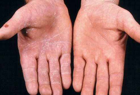 Tinea manuum finds its way onto human hands through either soil, animals, or human contact.