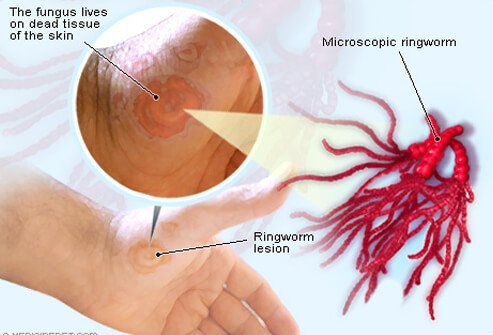 Although the world is full of yeasts, molds, and fungi, only a few cause skin problems.