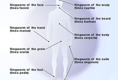 There are several types of ringworm of the skin, and they tend to specialize.
