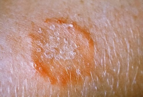Ringworm of the body (tinea corporis)