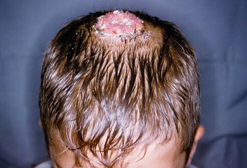 Tinea capitis is most common in children between the ages of 3 and 7, and is less often found in adults.