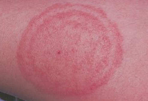 One of the most distinctive signs of tinea corporis is the appearance of an itchy, red, circular rash in the shape of a ring.
