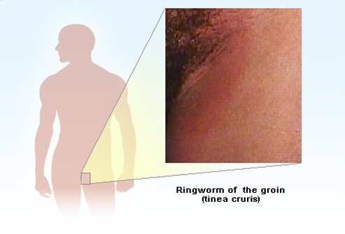 Another itchy problem is tinea cruris, more commonly known as jock itch.