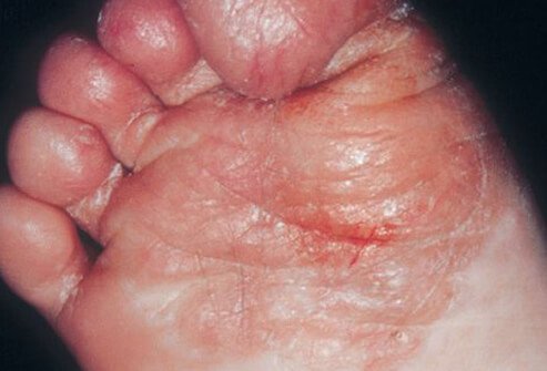 If you have tinea pedis, the good news is you’re not alone.