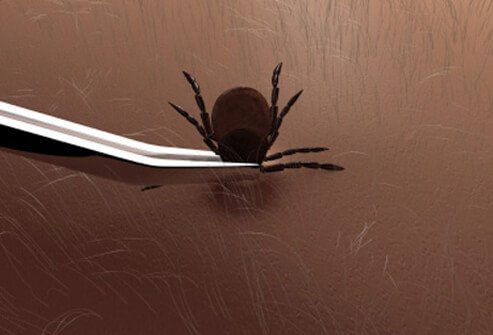 Use fine-tipped tweezers to remove ticks.