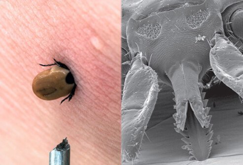Rocky Mountain spotted fever is transmitted by the bite of an infected tick.