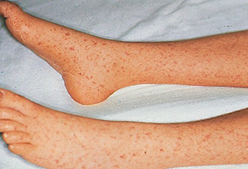 After two to three days, erythematous macules erupt on the wrists, hands, forearms, legs, and ankles of patients infected with Rocky Mountain spotted fever.