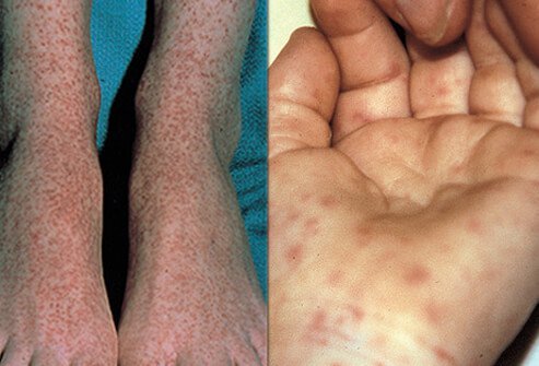 Rocky Mountain spotted fever on the ankles of an adolescent (left) and on the hands and wrists of a child (right).