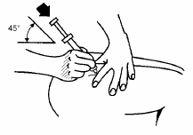 Hold the needle like a pencil at a 45° to 90° angle to skin - illustration Hold the needle like a pencil at a 45° to 90° angle to skin - illustration