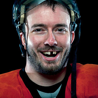 Trauma and fractures to teeth often require the need for a root canal.
