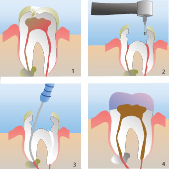 Illustration of a dental root canal procedure on a tooth.