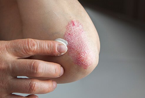 Psoriasis is characterized by skin cells that multiply up to 10 times faster than normal.