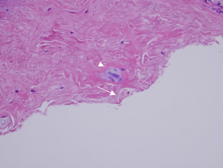 Pathology photo showing multinucleated giant cell granulomatous reaction (triangle point), synovial hyperplasia, fibrosis, and adjacent foreign vegetable matter (arrow with thorn fragments) with H&E stain.
