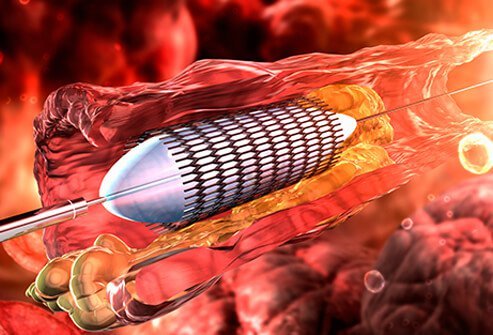 Angioplasty may help prevent heart attacks by opening clogged coronary arteries.