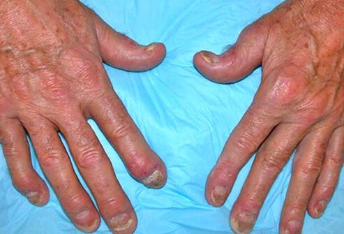Psoriasis can be associated with a destructive arthritis called psoriatic arthritis.