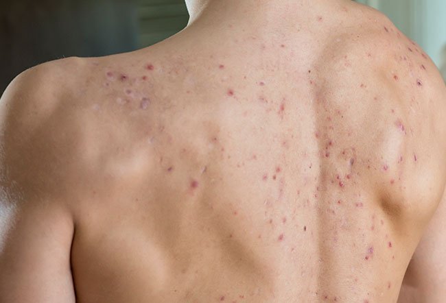 SAPHO syndrome symptoms and signs include acne and joint pain and stiffness.