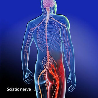 An illustration shows the location of the sciatic nerve.