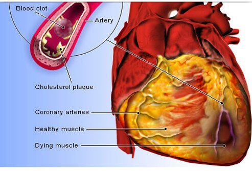 An illustration shows blockage of the coronary arteries by plaque which may cause a heart attack.
