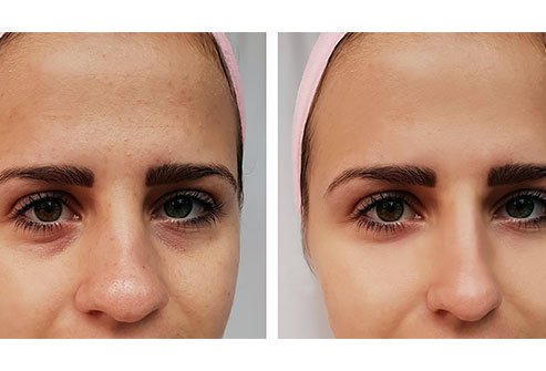 A septoplasty may correct and straighten a broken nose or deviated septum. A septoplasty may correct and straighten a broken nose or deviated septum.