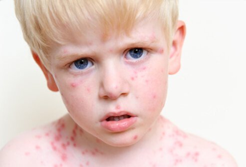 Chicken pox is an infectious disease that occurs when you come in contact with varicella-zoster virus, the same virus that causes shingles. 