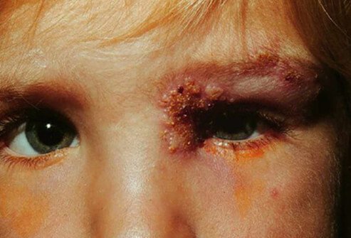 Shingles that spreads to the eye may lead to vision loss.