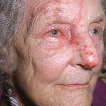 Ramsay Hunt syndrome, bacterial skin infection, blindness, encephalitis, and disseminated herpes zoster are complications of shingles.