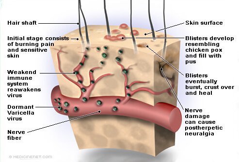 Shingles is caused by the same virus that causes chickenpox (varicella-zoster virus or VZV), a member of the herpes family of viruses.