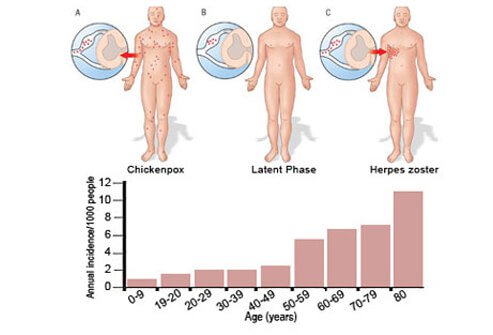 Increasing age is a risk factor for shingles. 