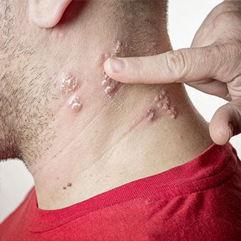 These blisters usually break open and ooze fluid. This may last about 5-7 days.