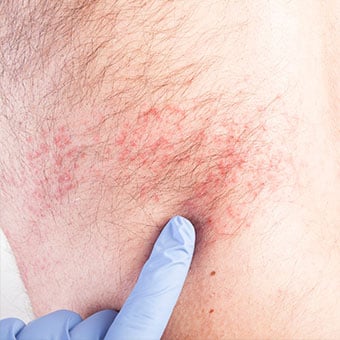 Shingles can often be diagnosed by your doctor based upon the distinctive appearance and distribution of the characteristic shingles rash.