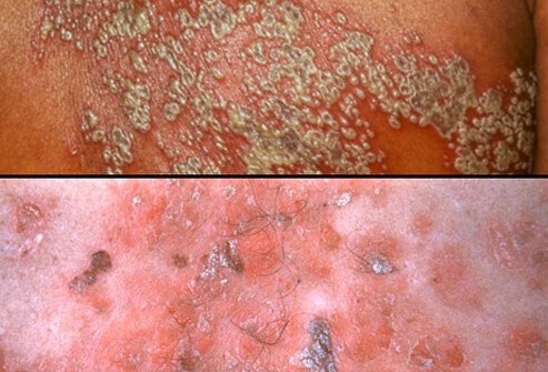 After zoster fluid-filled blisters pop, the lesions ooze, crust over, and then heal. 