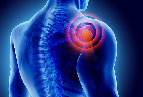 A muscle strain is an injury that occurs when a muscle or a tendon is overstretched. A muscle tear is when a muscle or a tendon is overstretched and it tears. Is a muscle strain is not the same thing as a muscle tear.