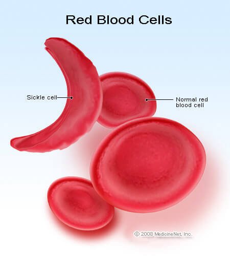 Picture of Sickle Cell Red Blood Cell