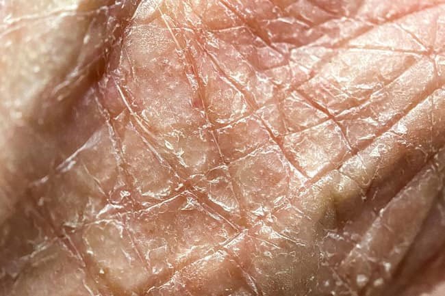 Dry skin lacks oil while dehydrated skin doesn't have enough internal moisture.