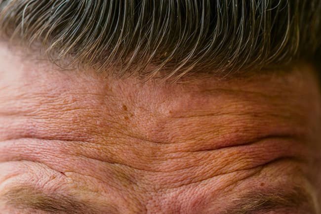 Dehydration may lead to increased fine lines. 
