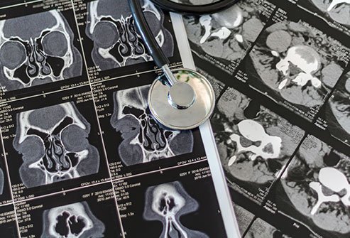 MRI studies of inflamed and infected sinus cavities.