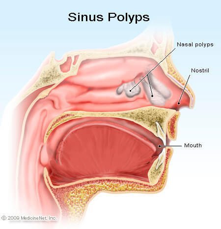 Picture of nasal polyps