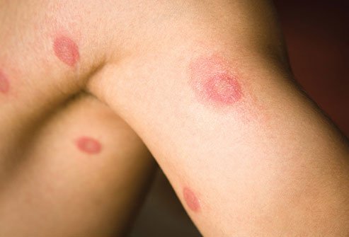 Ringworm is a well-known fungal infection that is common, especially in school-age children.