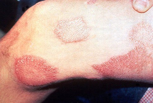 Leprosy is a very slow-growing bacterial skin infection.