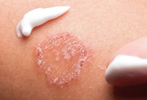 For bacterial skin infections, your doctor may prescribe antibiotics.