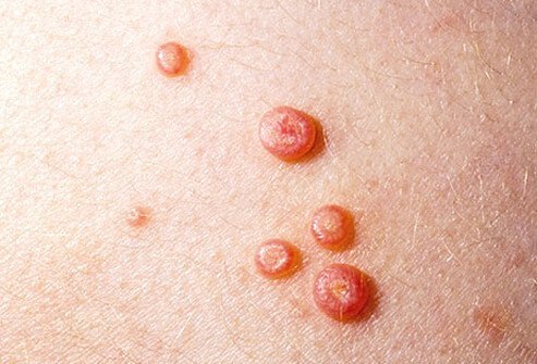 Mollusca are painless, pearl-like lesions that form after infection from a virus.