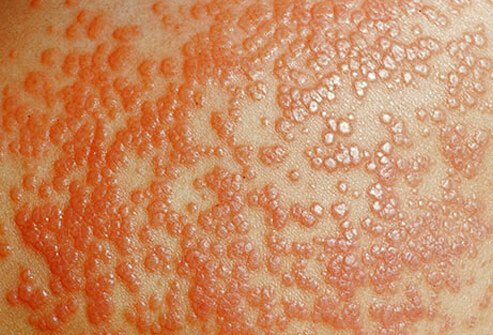 Genital warts are tiny, fleshy growths that usually develop around the penis in men or around the vaginal entrance in women.