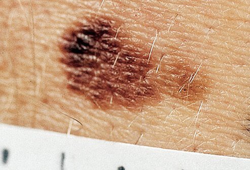 Measuring the diameter of an atypical mole.