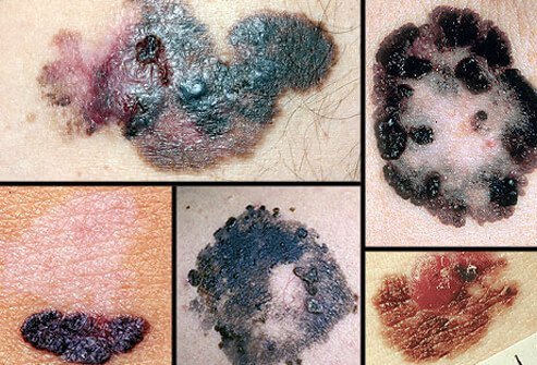 Collage of melanoma.