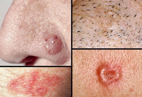 Collage of basal cell carcinoma.