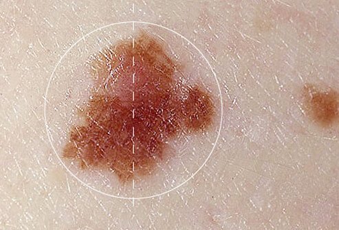 Asymmetrical mole, a melanoma symptom.