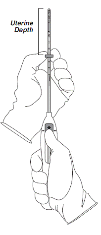 Setting the flange - Illustration Setting the flange - Illustration