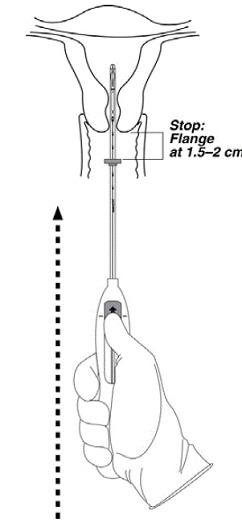 Advancing insertion tube until flange is 1.5
to 2 cm from the cervix - Illustration Advancing insertion tube until flange is 1.5
to 2 cm from the cervix - Illustration