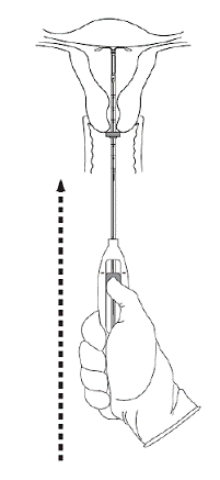 Move Skyla into
the fundal position - Illustration Move Skyla into
the fundal position - Illustration