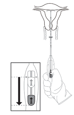 Move the slider
all the way down to release Skyla from the insertion tube - Illustration Move the slider
all the way down to release Skyla from the insertion tube - Illustration